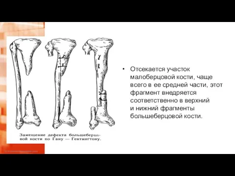 Отсекается участок малоберцовой кости, чаще всего в ее средней части, этот фрагмент