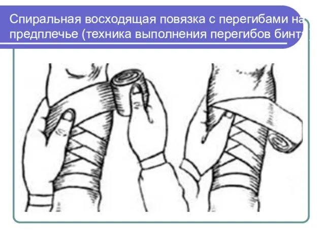 Спиральная восходящая повязка с перегибами на предплечье (техника выполнения перегибов бинта)