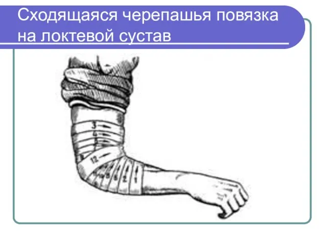 Сходящаяся черепашья повязка на локтевой сустав