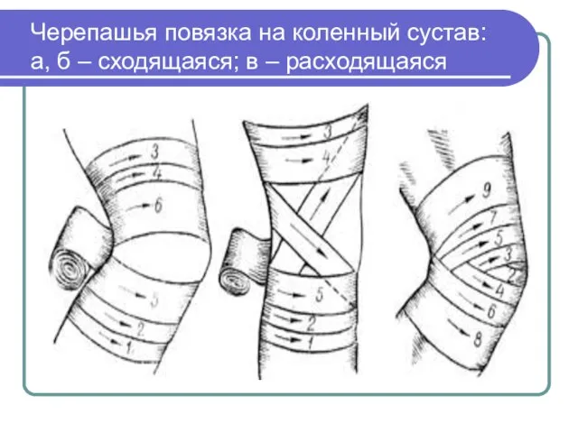 Черепашья повязка на коленный сустав: а, б – сходящаяся; в – расходящаяся