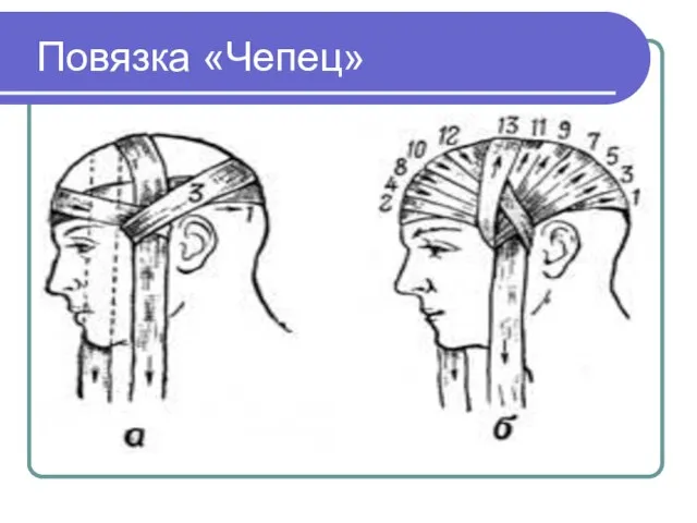 Повязка «Чепец»