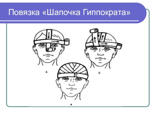 Повязка «Шапочка Гиппократа»