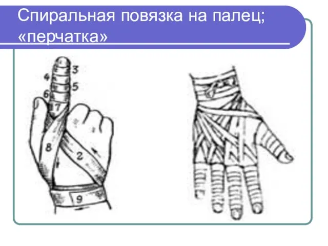 Спиральная повязка на палец; «перчатка»