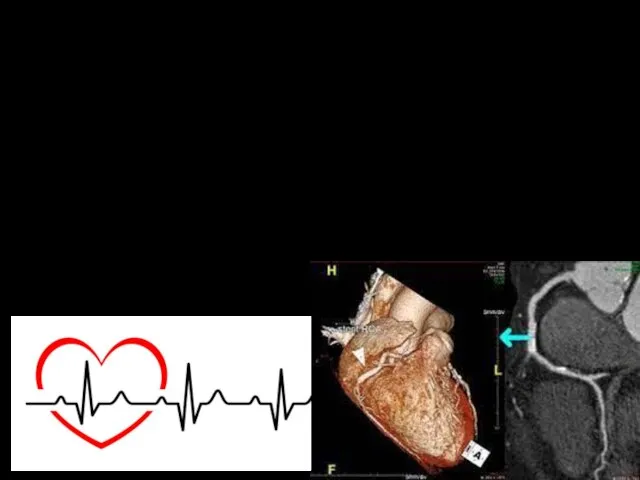 Метод: МСКТ Область исследования: сердце Контрастное в-во: Омнипак Имеется коронарный стент