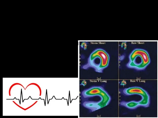 Метод: сцинтиграфия миокарда Область исследования: сердце Имеются участки с недостаточным Кровоснабжением – ишемия миокарда.