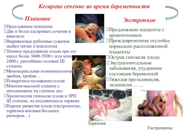 Кесарево сечение во время беременности Плановое Экстренное Предлежание плаценты Два и более