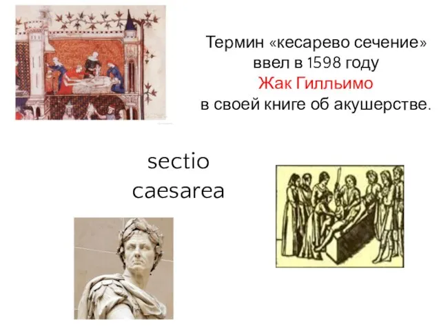 Термин «кесарево сечение» ввел в 1598 году Жак Гилльимо в своей книге об акушерстве. sectio caesarea