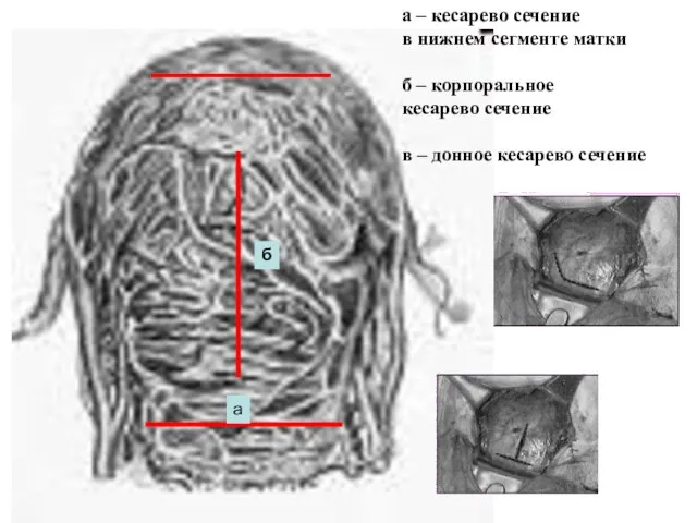 а б а – кесарево сечение в нижнем сегменте матки б –