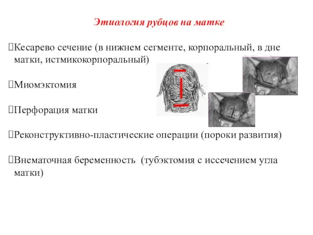 Этиология рубцов на матке Кесарево сечение (в нижнем сегменте, корпоральный, в дне