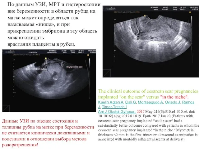 По данным УЗИ, МРТ и гистероскопии вне беременности в области рубца на