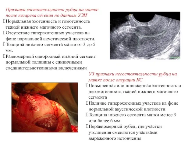 Признаки состоятельности рубца на матке после кесарева сечения по данным УЗИ Нормальная