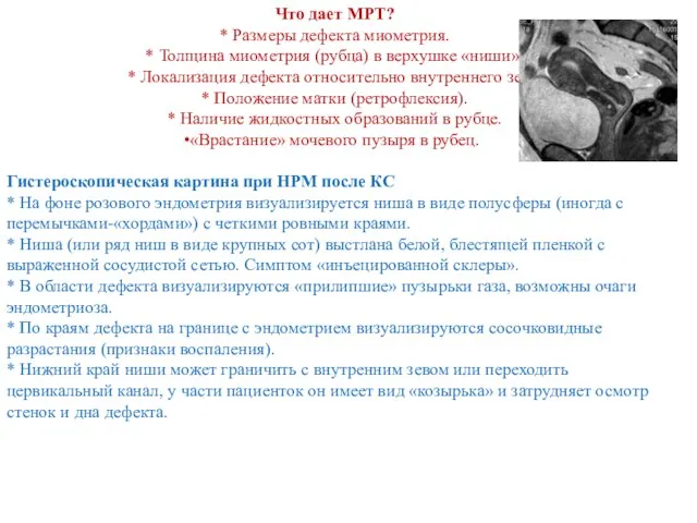 Что дает МРТ? * Размеры дефекта миометрия. * Толщина миометрия (рубца) в