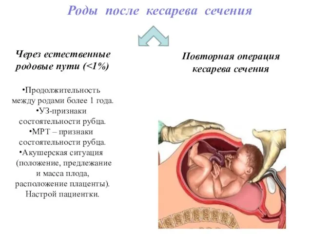 Роды после кесарева сечения Через естественные родовые пути ( Продолжительность между родами