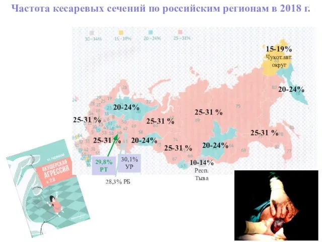 Частота кесаревых сечений по российским регионам в 2018 г. 25-31 % 25-31