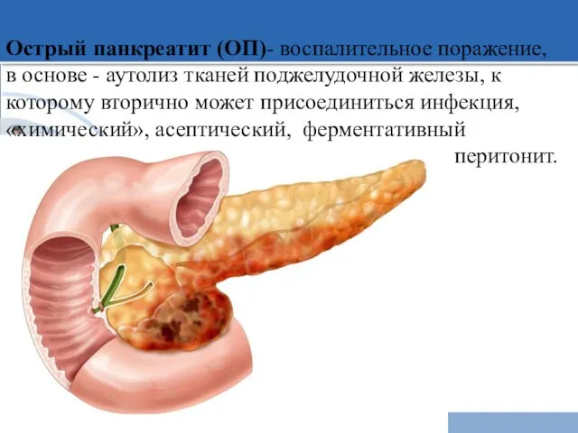 Острый панкреатит (ОП)- воспалительное поражение, в основе - аутолиз тканей поджелудочной железы,