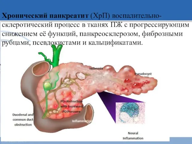 Хронический панкреатит (ХрП) воспалительно-склеротический процесс в тканях ПЖ с прогрессирующим снижением её