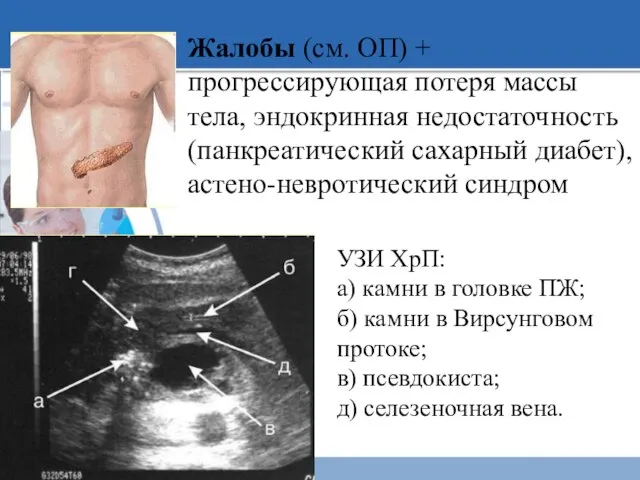 Жалобы (см. ОП) + прогрессирующая потеря массы тела, эндокринная недостаточность (панкреатический сахарный