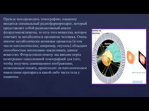 Прежде чем проводить томографию, пациенту вводится специальный радиофармпрепарат, который представляет собой радиоактивный