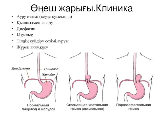 Өңеш жарығы.Клиника Ауру сезімі (кеуде қуысында) Қышқылмен кекіру Дисфагия Ықылық Тілдің күйдіру сезімі,ауруы Жүрек айну,құсу