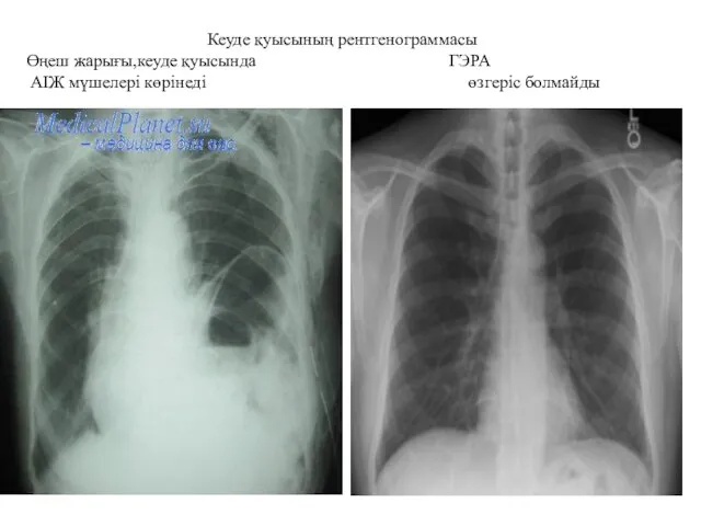 Кеуде қуысының рентгенограммасы Өңеш жарығы,кеуде қуысында ГЭРА АІЖ мүшелері көрінеді өзгеріс болмайды