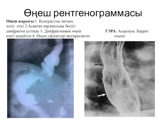 Өңеш рентгенограммасы Өңеш жарығы.1. Контрастты заттың әлсіз өтуі 2.Асқазан кардиальды бөлігі диафрагма