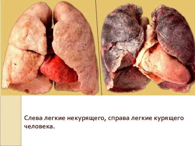 Слева легкие некурящего, справа легкие курящего человека.