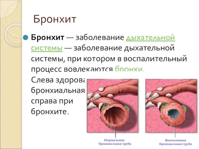 Бронхит Бронхит — заболевание дыхательной системы — заболевание дыхательной системы, при котором