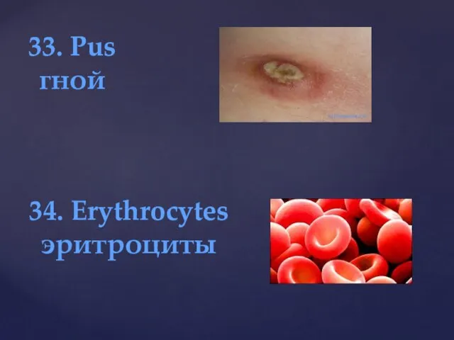 33. Pus гной 34. Erythrocytes эритроциты