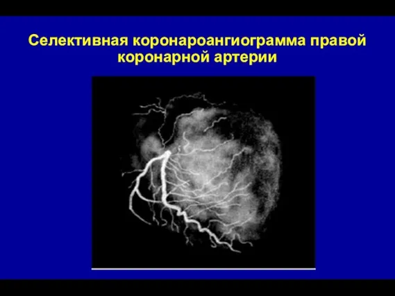 Селективная коронароангиограмма правой коронарной артерии