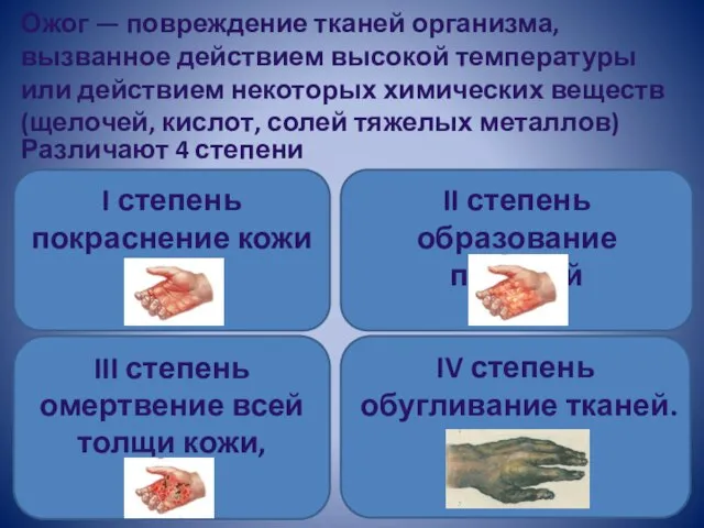 Ожог — повреждение тканей организма, вызванное действием высокой температуры или действием некоторых