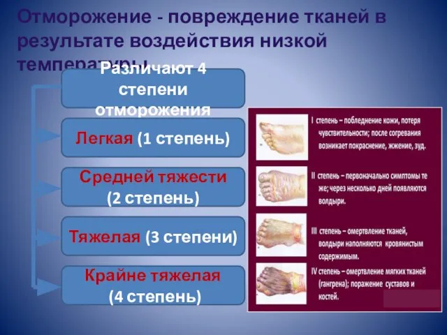 Отморожение - повреждение тканей в результате воздействия низкой температуры. Различают 4 степени