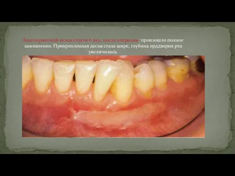 Благоприятный исход спустя 6 нед. после операции: произошло полное заживление. Прикрепленная десна
