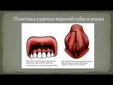 Пластика уздечки верхней губы и языка