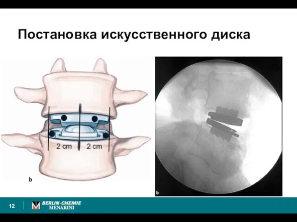 Постановка искусственного диска