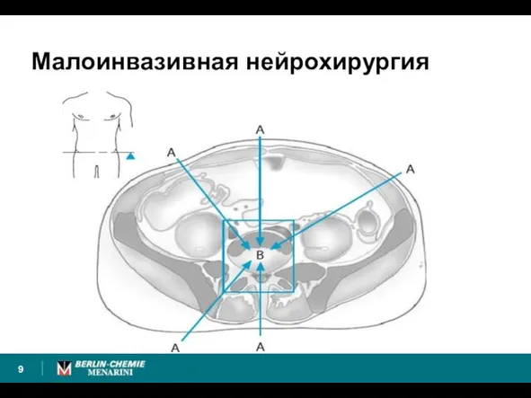 Малоинвазивная нейрохирургия