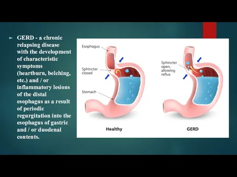 GERD - a chronic relapsing disease with the development of characteristic symptoms