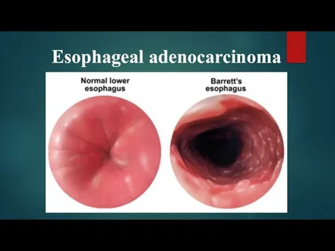 Esophageal adenocarcinoma