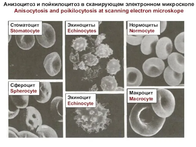 Анизоцитоз и пойкилоцитоз в сканирующем электронном микроскопе Anisocytosis and poikilocytosis at scanning