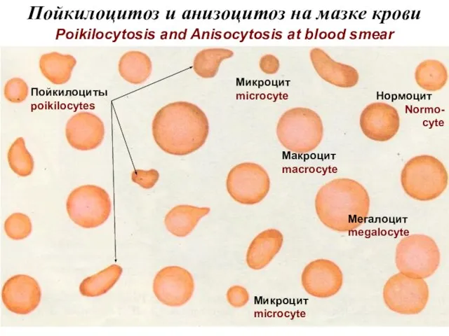 Пойкилоцитоз и анизоцитоз на мазке крови Poikilocytosis and Anisocytosis at blood smear