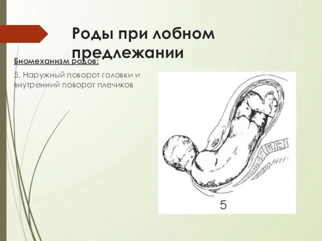 Роды при лобном предлежании Биомеханизм родов: 5. Наружный поворот головки и внутренний поворот плечиков