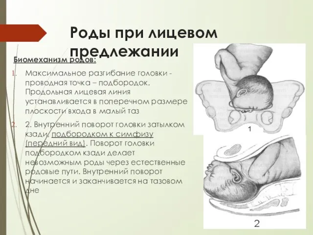 Роды при лицевом предлежании Биомеханизм родов: Максимальное разгибание головки - проводная точка