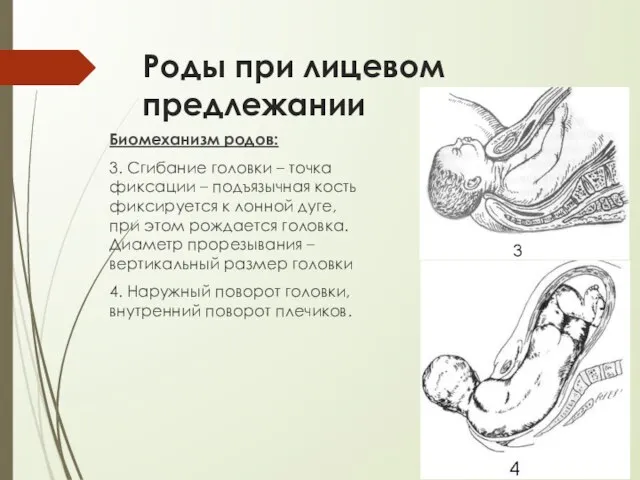 Роды при лицевом предлежании Биомеханизм родов: 3. Сгибание головки – точка фиксации