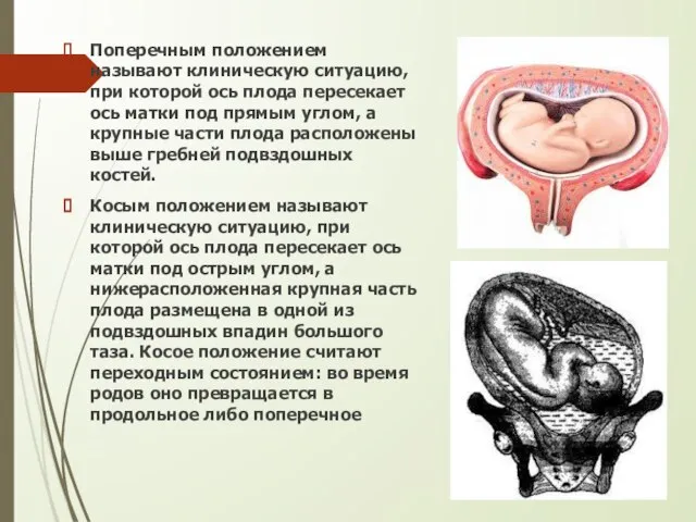 Поперечным положением называют клиническую ситуацию, при которой ось плода пересекает ось матки