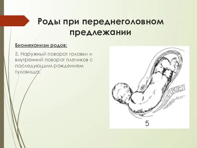 Роды при переднеголовном предлежании Биомеханизм родов: 5. Наружный поворот головки и внутренний