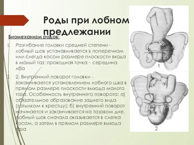 Роды при лобном предлежании Биомеханизм родов: Разгибание головки средней степени - лобный