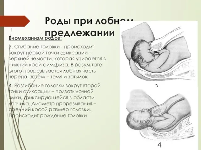 Роды при лобном предлежании Биомеханизм родов: 3. Сгибание головки - происходит вокруг