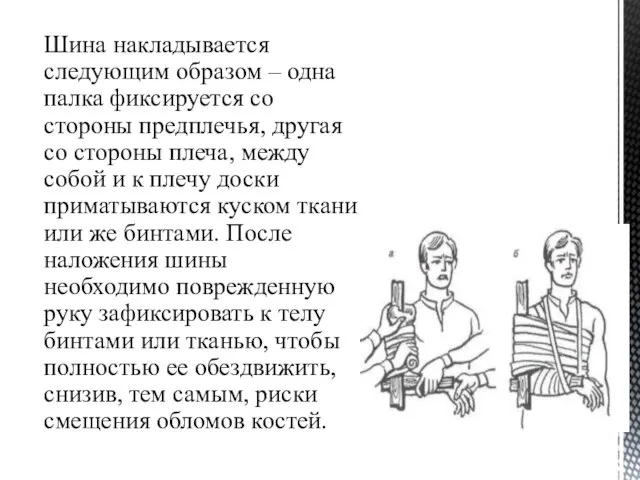 Шина накладывается следующим образом – одна палка фиксируется со стороны предплечья, другая