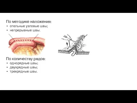 По методике наложения: отельные узловые швы; непрерывные швы. По количеству рядов: однорядные