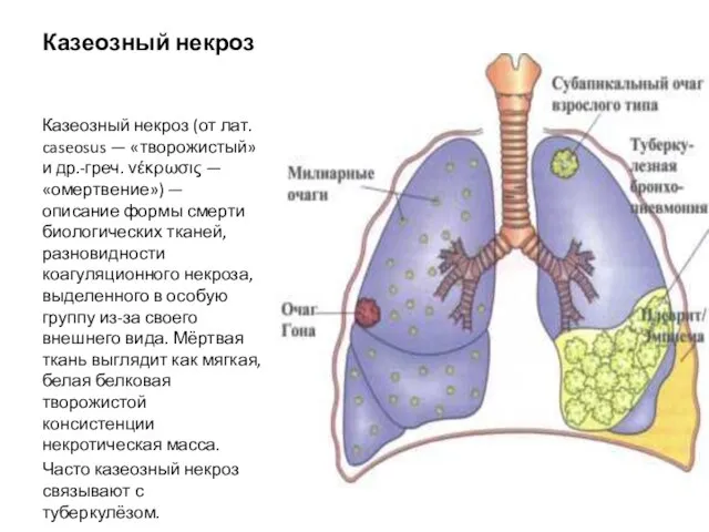 Казеозный некроз Казеозный некроз (от лат. caseosus — «творожистый» и др.-греч. νέκρωσις