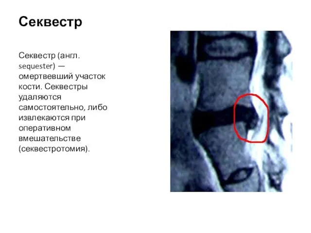 Секвестр Секвестр (англ. sequester) — омертвевший участок кости. Секвестры удаляются самостоятельно, либо